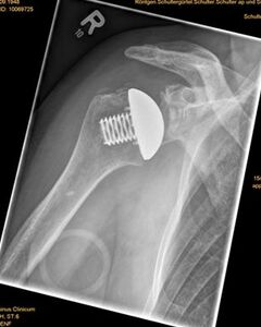 Röntgenbild nach implantierter Eclipse-Prothese mit Ersatz der Gelenkpfanne