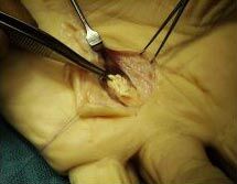 zerstörter körpernaher Sehnenstumpf der tiefen Fingerbeugesehne IV