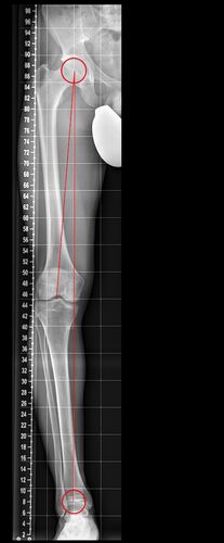 Röntgenaufnahme der Ausgangssituation (O-Bein)