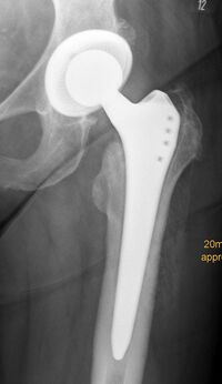 Lockerung eines zementfreien Hüftprothesenschaftes, typischer Lockerungssaum an der Prothesen-/Knochengrenze: