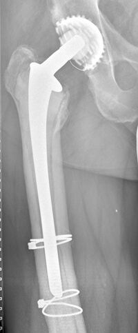 Lockerung eines zementierten Hüftprothesenschaftes, typischer Lockerungssaum an der Knochen-/Zementgrenze: