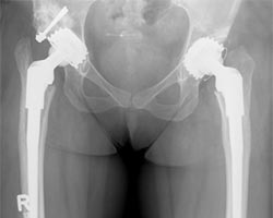Postoperatives Röntgenbild nach beidseitiger Implantation von Hüftendoprothesen Rechts mit Harris-Plastik (Anschrauben eines Knochenblocks am Becken)